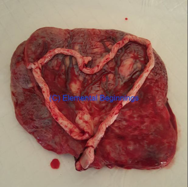 False knots in umbilical cord | Elemental Beginnings | Placenta encapsulation Adelaide