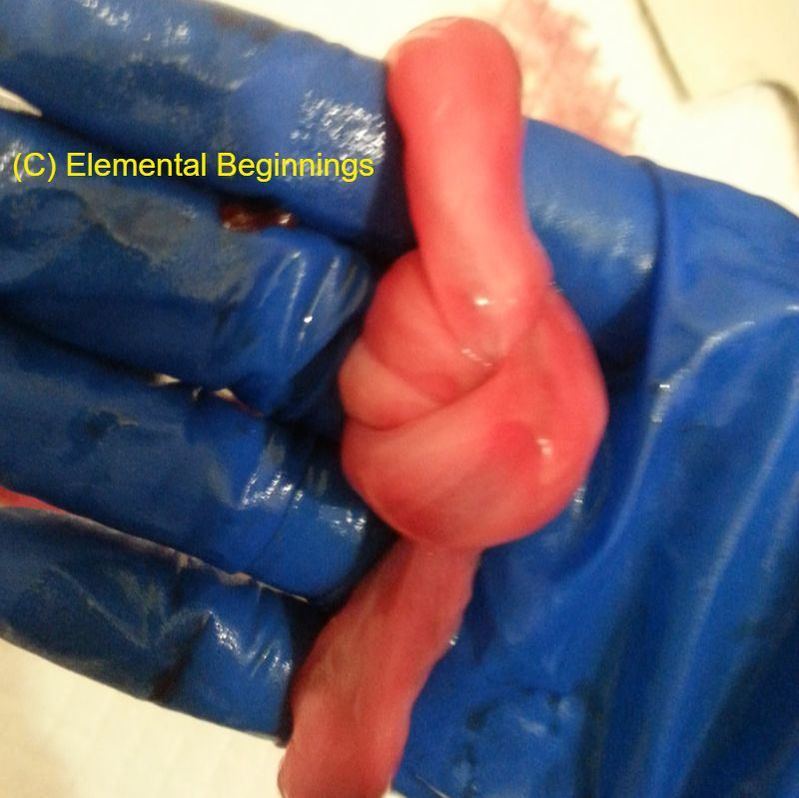 True knot in an umbilical cord | Elemental Beginnings | Placenta encapsulation Adelaide